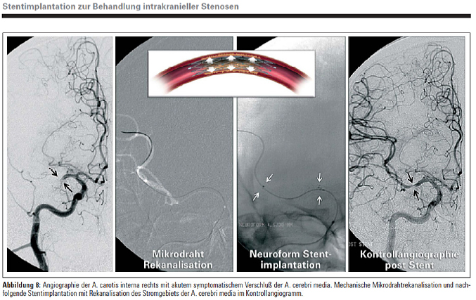 Stenting implentation for the treatment of intracranial stenoses