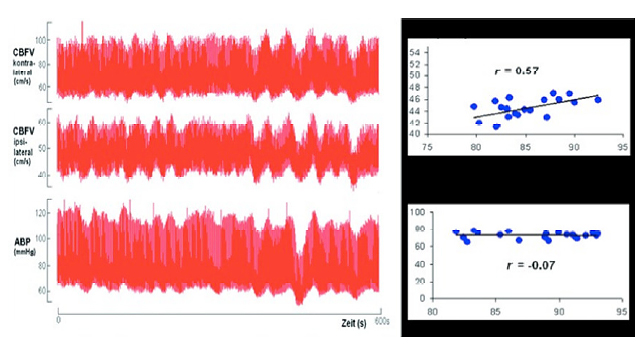 Determination of dynamic autoregulation by Doppler monitoring in a 59-year-old female patient with left internal carotid artery occlusion
