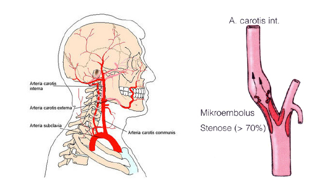 Anatomy of extracranial vessel system and typical carotid-stenosis