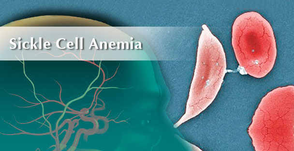 Sickle Cell Anemia