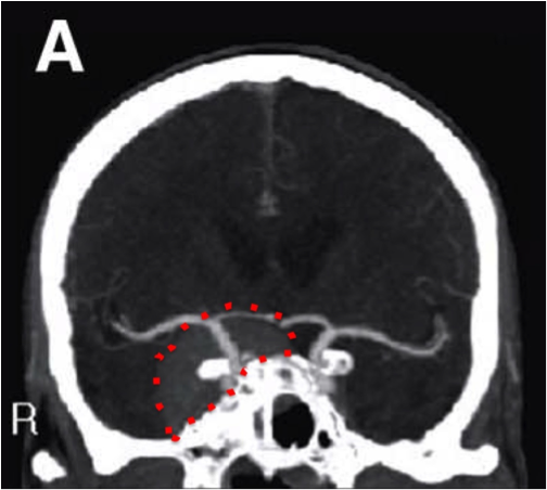 Image showing tumor in the base of scull