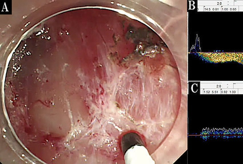 Endoscopic Diagnosis of esophageal varices